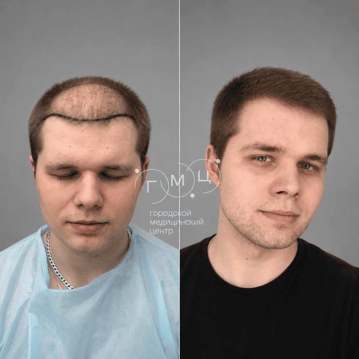 до и после пересадки
