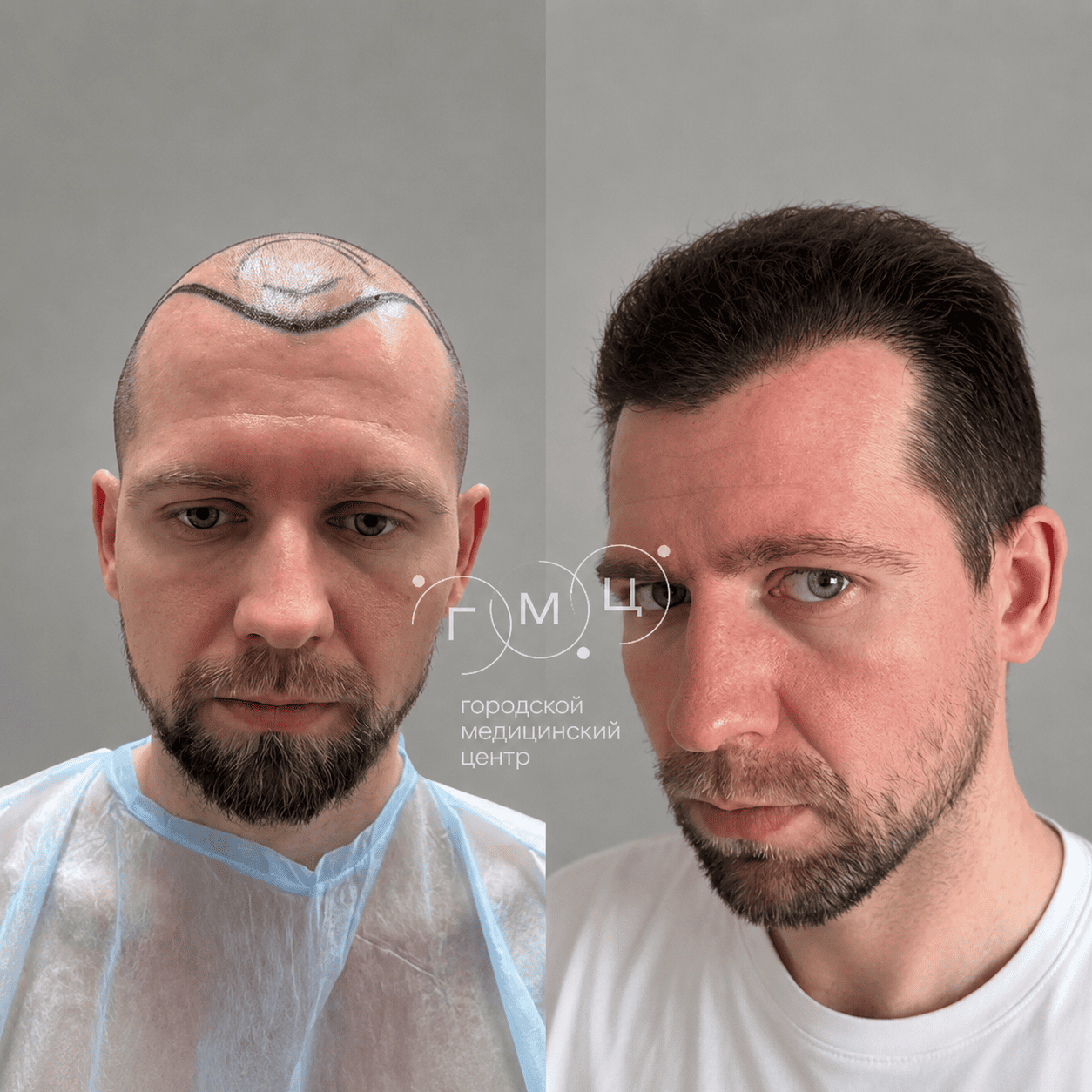 до и после пересадки