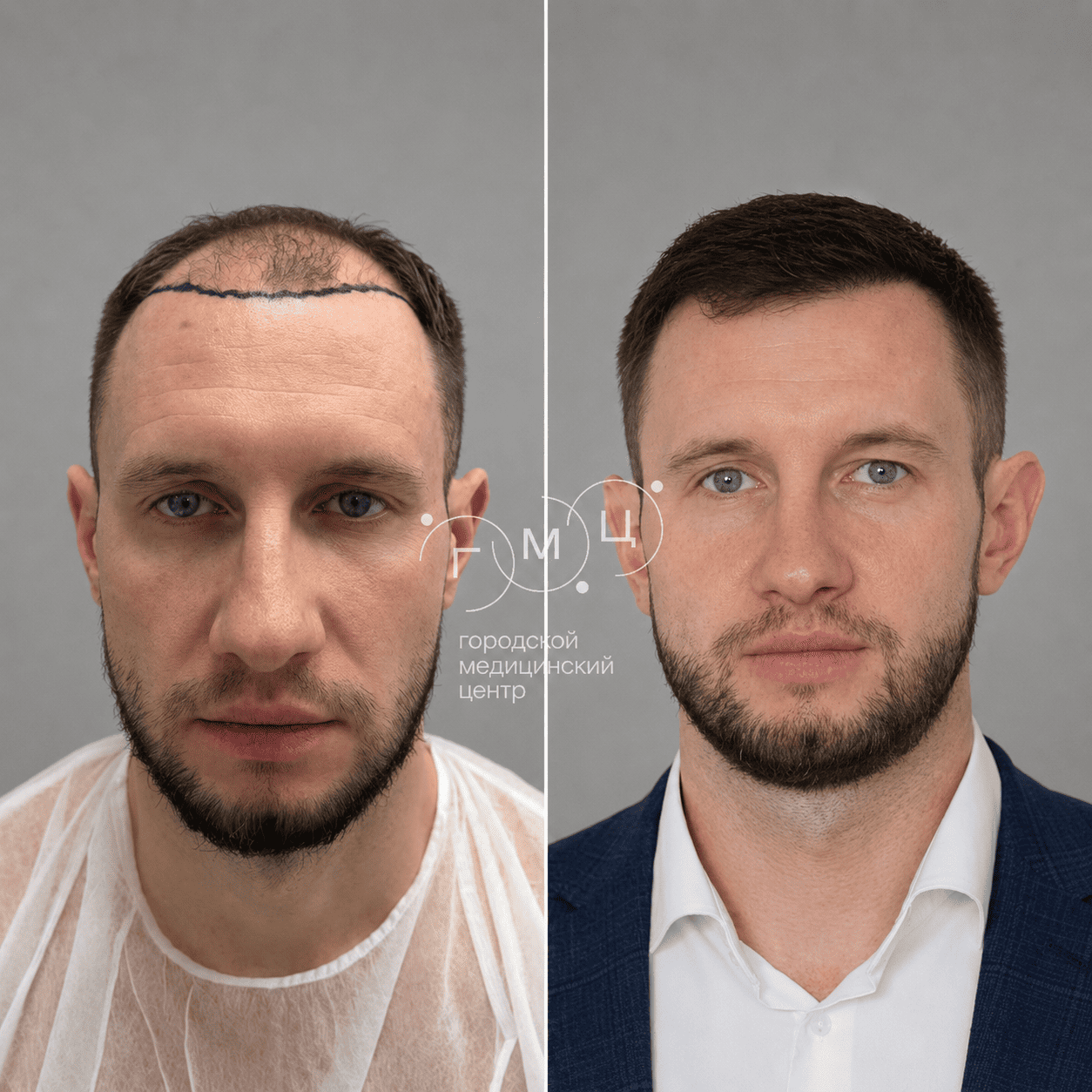 до и после пересадки